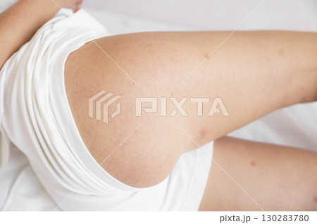 close-up of a woman's upper thigh and hip in white shorts, soft natural light, healthy skin texture, minimal medical or aesthetic context, body part detail close-up of a woman's upper thigh and hip in white shorts, soft natural light, healthy skin texture, minimal medical or aesthetic context, body part detail 130283780