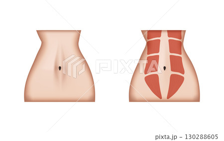 Woman showing abdominal diastasis recti and recovery after exercises 130288605
