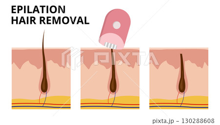 Electric epilator removing hair from underneath skin surface 130288608