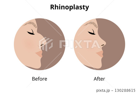 Woman profile showing rhinoplasty results, before and after Woman profile showing rhinoplasty results, before and after 130288615