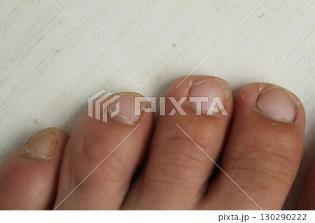 Toes close-up. Toenail care, pedicure 130290222
