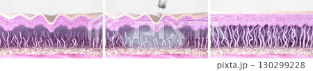 Fibroblasts, collagen, and elastin fibers in aged skin before and after dermal filler injection. Matrix cell rejuvenation and new collagen synthesis in the skin layers, wrinkle reduction. 3d render Fibroblasts, collagen, and elastin fibers in aged skin before and after dermal filler injection. Matrix cell rejuvenation and new collagen synthesis in the skin layers, wrinkle reduction. 3d render 130299228
