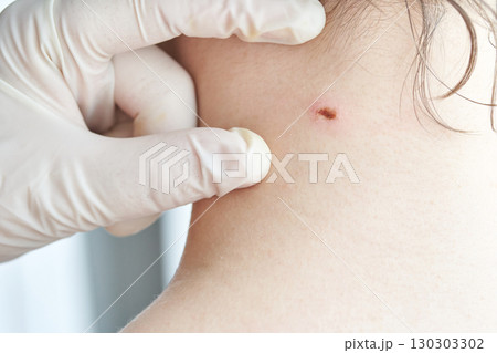 Close-up of skin examination on caucasian female neck by gloved hands Close-up of skin examination on caucasian female neck by gloved hands 130303302