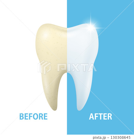 Tooth Whitening Before, After. Vector Illustration. Dental Care and Healthy Smile Concept. Cosmetic Teeth Whitening, Enamel Cleaning, Bright White Tooth, Oral Hygiene, Dental Treatment, Perfect Smile 130308645