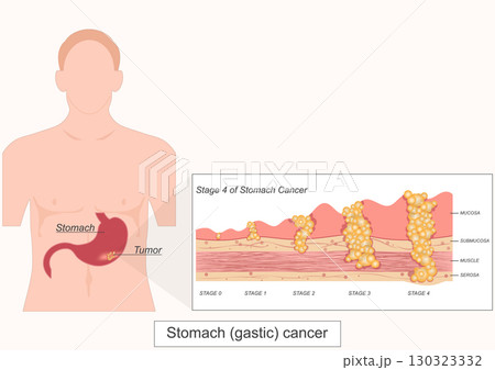 Stage4 of Stomach gastric cancer is cancer that start in the cells. 130323332