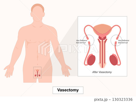 Vasectomy is a permanent surgical method of male birth control . Vasectomy is a permanent surgical method of male birth control . 130323336