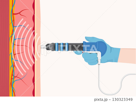Extracorporeal Shock Wave Therapy (ESWT) is a non-invasive medical treatment using 130323349
