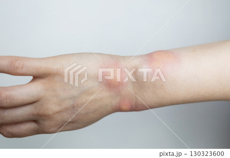 Close up of a swollen wrist with visible redness, inflammation, caused by an insect bite or allergic reaction. The hand signs of rash, itching, and local pain, typical of mosquito bites, bee stings 130323600
