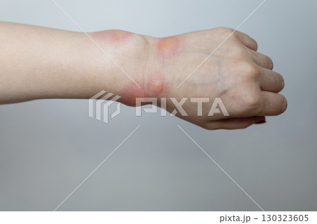 Close up of a swollen wrist with visible redness, inflammation, caused by an insect bite or allergic reaction. The hand signs of rash, itching, and local pain, typical of mosquito bites, bee stings 130323605
