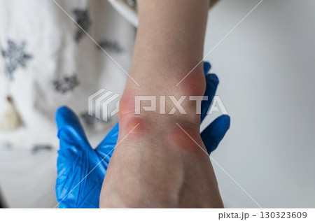Close up of a swollen wrist with visible redness, inflammation, caused by an insect bite or allergic reaction. The hand signs of rash, itching, and local pain, typical of mosquito bites, bee stings 130323609