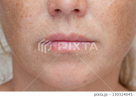 Cold sore on womans lip Cold sore on womans lip 130324045