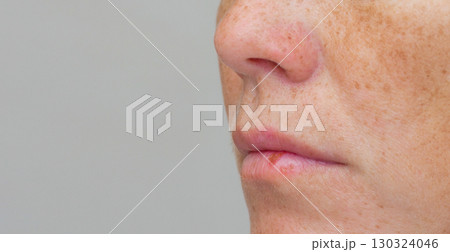 Side view of cropped face with herpes on lower lip Side view of cropped face with herpes on lower lip 130324046