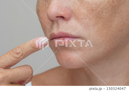 Woman pointing at herpes on lip 130324047