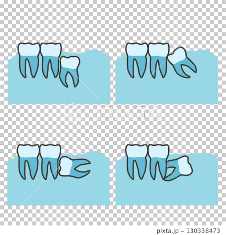 Illustration of how wisdom teeth are buried Illustration of how wisdom teeth are buried 130338473