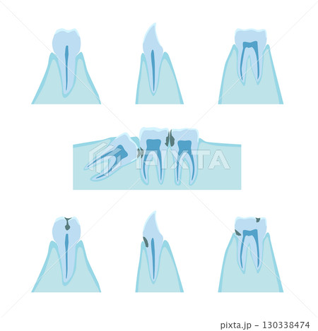 歯と歯茎と虫歯の断面イメージイラスト 130338474