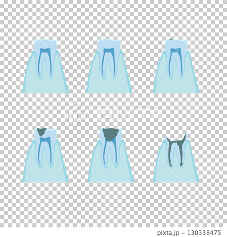 蛀牙進展的橫斷面圖 130338475