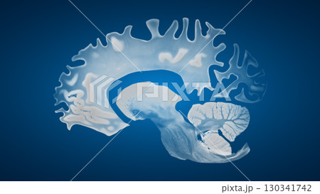 Sagittal Brain Showing Cortical Atrophy in Alzheimer Disease Sagittal Brain Showing Cortical Atrophy in Alzheimer Disease 130341742