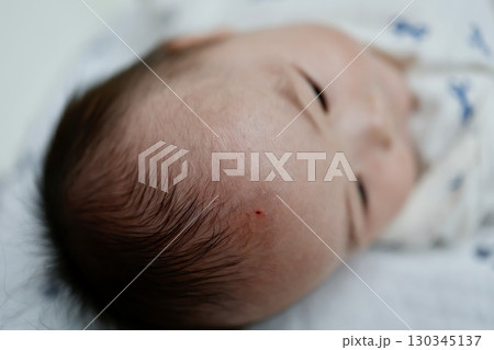 生後半年の赤ちゃんがおでこを引っ掻き怪我した様子の写真 生後半年の赤ちゃんがおでこを引っ掻き怪我した様子の写真 130345137