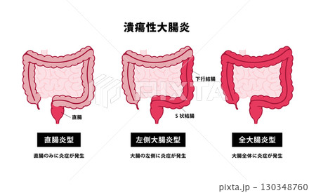 潰瘍性大腸炎の種類 ベクターイラスト 潰瘍性大腸炎の種類 ベクターイラスト 130348760