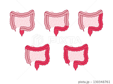 潰瘍性大腸炎の種類 (文字なし) ベクターイラスト 潰瘍性大腸炎の種類 (文字なし) ベクターイラスト 130348761