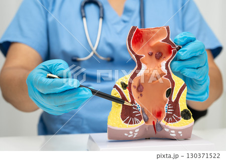 Asian doctor with rectum and hemorrhoid human anatomy model at hospital, inflamed vascular structure. Asian doctor with rectum and hemorrhoid human anatomy model at hospital, inflamed vascular structure. 130371522