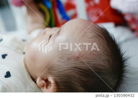 赤ちゃんの額にできた蚊の刺され跡 赤ちゃんの額にできた蚊の刺され跡 130390432