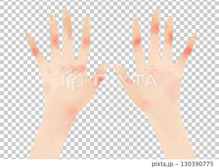 Watercolor illustration of chapped hands 130390775