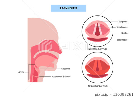 Laryngitis medical poster 130398261