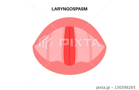Laryngospasm medical poster 130398265