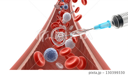 A medical illustration shows a syringe injecting a substance into a blood vessel. A medical illustration shows a syringe injecting a substance into a blood vessel. 130399330