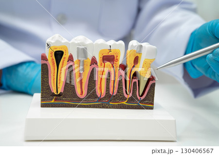 Dentist holding dental implant, artificial tooth roots into jaw, root canal of dental treatment, gum disease, teeth model for dentist. 130406567