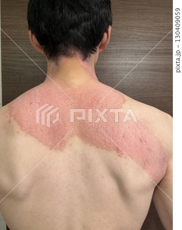 皮膚病　乾癬 130409059