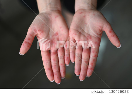 Close-up of human palms with red rash caused by Coxsackievirus, showing hand-foot-mouth disease symptoms. Close-up of human palms with red rash caused by Coxsackievirus, showing hand-foot-mouth disease symptoms. 130426028