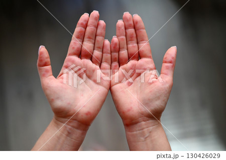 Close-up of human palms with red rash caused by Coxsackievirus, showing hand-foot-mouth disease symptoms. 130426029