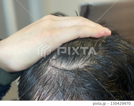 脂漏生皮膚炎・フケ・薄毛で悩む人の頭皮 130429970