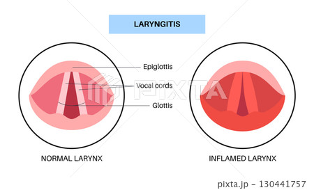 Laryngitis medical poster 130441757