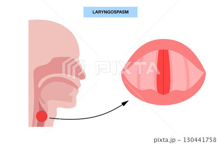 Laryngospasm medical poster 130441758