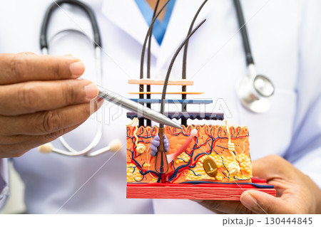 Hair transplant, Asian dermatologist doctor holding skin structure anatomy model for treatment in hospital. 130444845