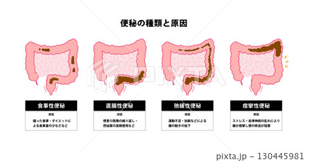 便秘の種類と原因 ベクターイラスト 130445981
