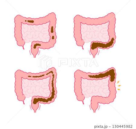 便秘の種類と原因 ベクターイラスト 130445982