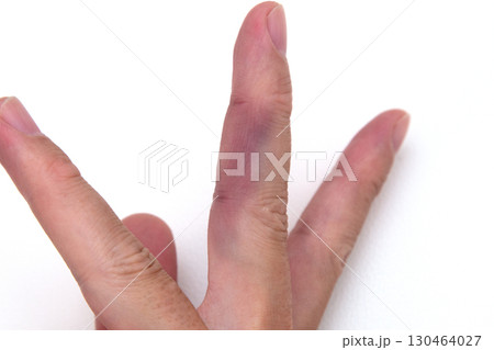 アッヘンバッハ症候群（急に中指が痛くて青紫色なる病気） 130464027