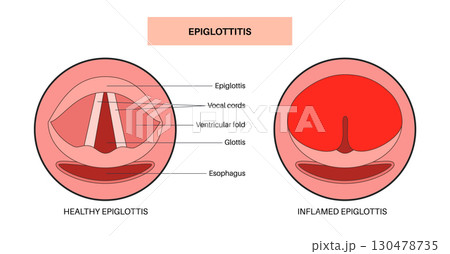 Epiglottitis medical poster 130478735