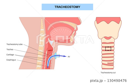 Tracheostomy medical poster 130498476
