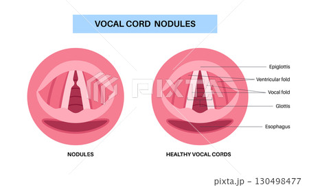 Vocal cord nodules Vocal cord nodules 130498477