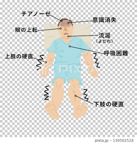 医療イラスト｜痙攣発作の症状（意識消失・眼球上転・チアノーゼ・呼吸困難）教育用素材 130502528