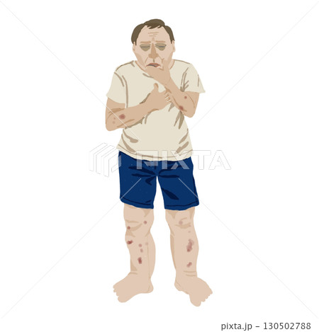 医療イラスト|腎不全患者の症状(皮膚変化・倦怠感・浮腫)教育用素材 医療イラスト|腎不全患者の症状(皮膚変化・倦怠感・浮腫)教育用素材 130502788