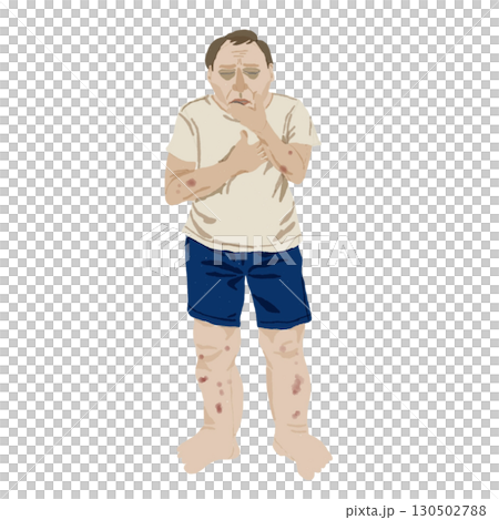 医療イラスト|腎不全患者の症状(皮膚変化・倦怠感・浮腫)教育用素材 医療イラスト|腎不全患者の症状(皮膚変化・倦怠感・浮腫)教育用素材 130502788