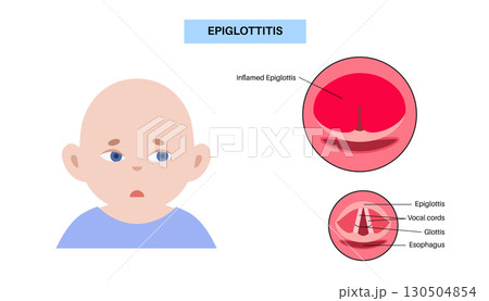 Epiglottitis medical poster 130504854