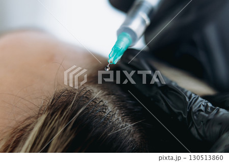 close up on woman head getting mesotherapy injections for stronger and healthier hair 130513860