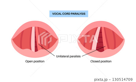 Vocal cords paralysis 130514709